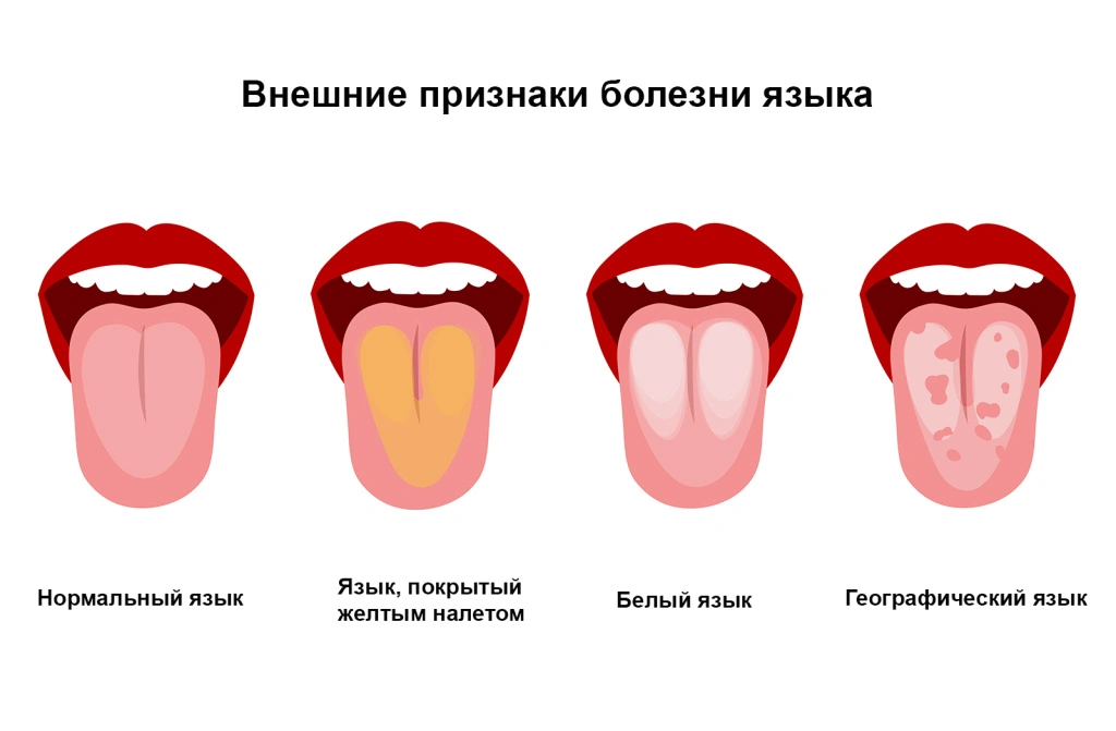 tongue_disase_types.jpg tongue_disase_types.jpg