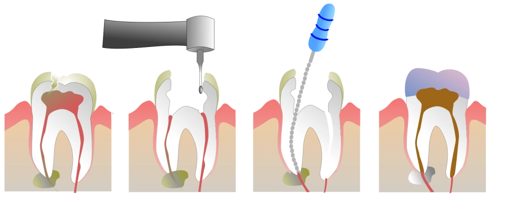 Root_Canal_Illustration_Molar.svg.png Root_Canal_Illustration_Molar.svg.png
