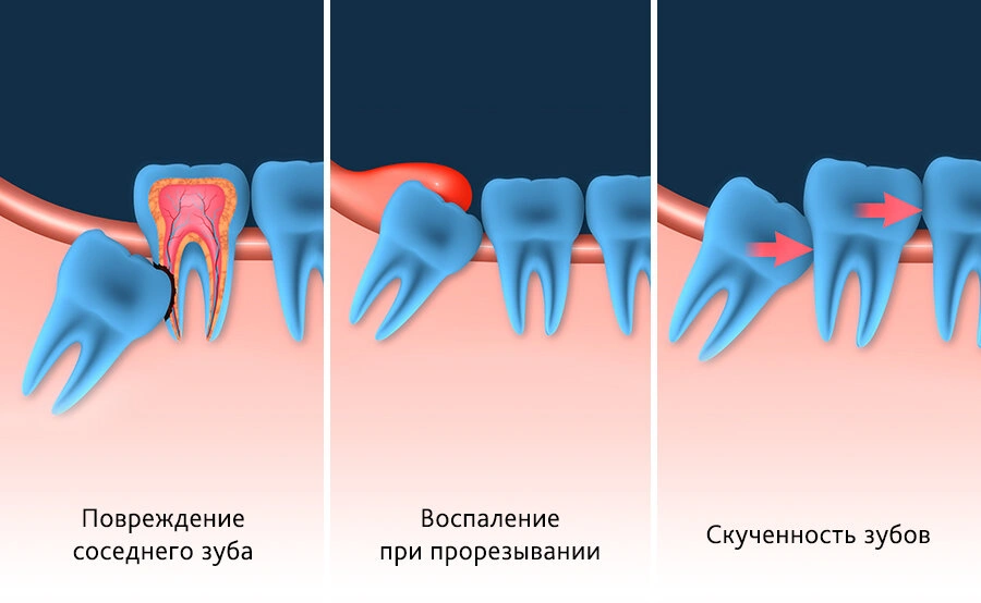 удаление зуба мудрости.jpg удаление зуба мудрости.jpg