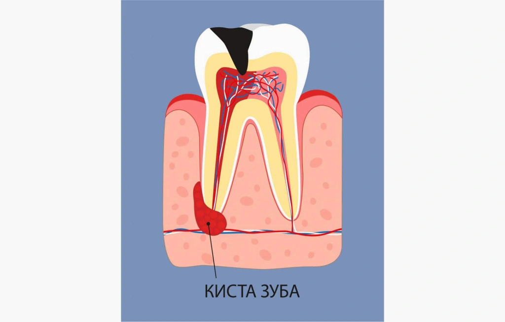 Tooth-cyst-1.jpg