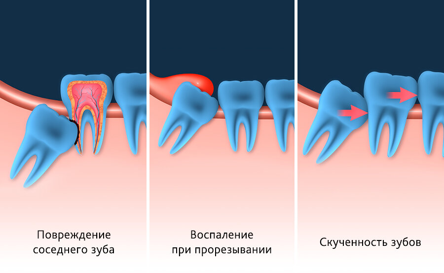 удаление зуба мудрости.jpg